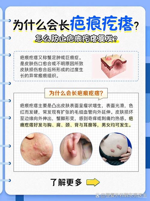 疤痕增生期的预防与处理措施(疤痕增生期如何护理)