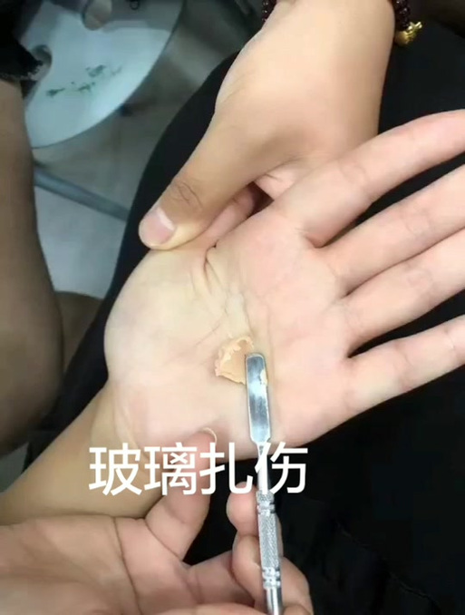 木刺、玻璃碎屑等异物的无菌取出技巧(木刺怎么去除)