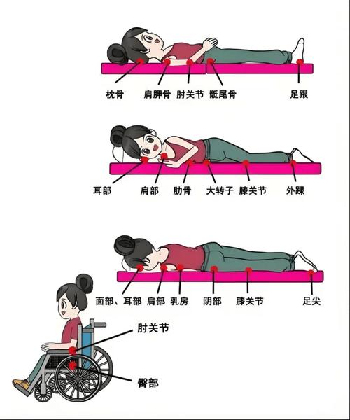 卧床病人预防压疮的体位摆放图解(长期卧床的病人,难免压疮如何评估及避免?)