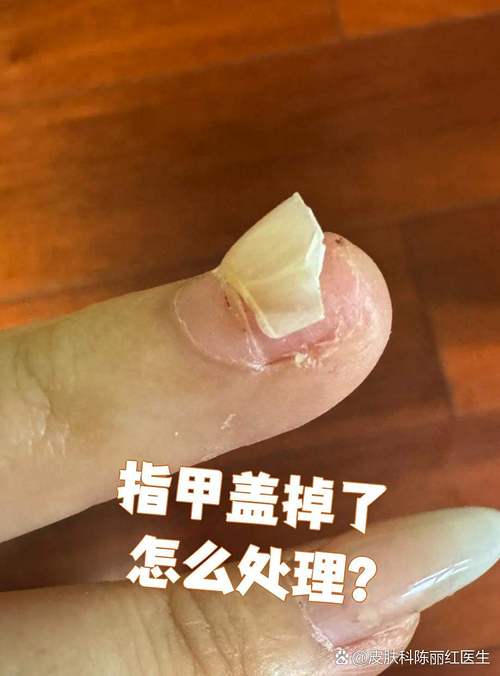 指甲受伤或脱落的紧急处置方法（指甲受伤脱落怎么治疗）