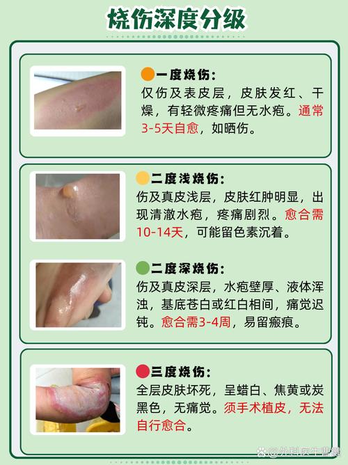 不同种类烧伤的深度识别与对应处理(阐述烧伤深度的分类及特点)