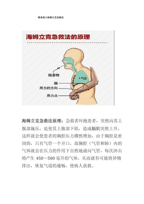 食物呛喉的海姆立克法（海姆立克噎住）
